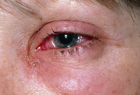 Eye irritation caused by viral conjunctivitis.