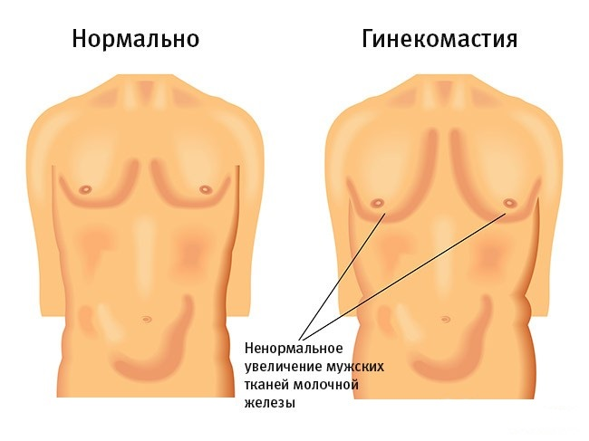 Гинекомастия