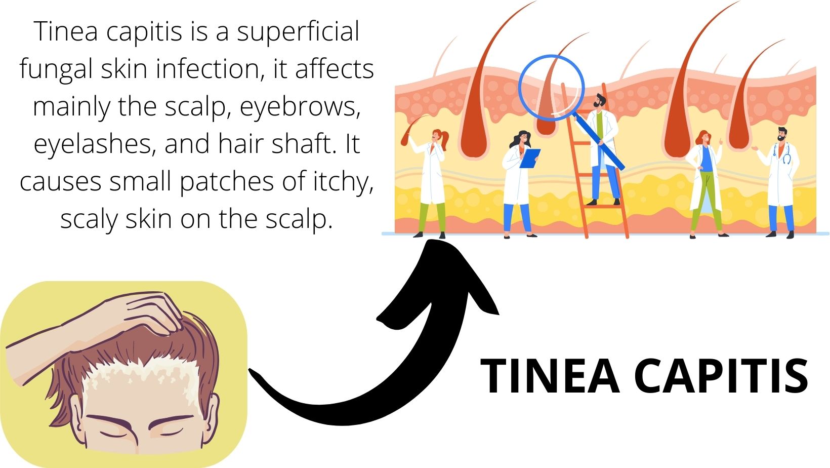 Fungal Infection Images - Tinea barbae