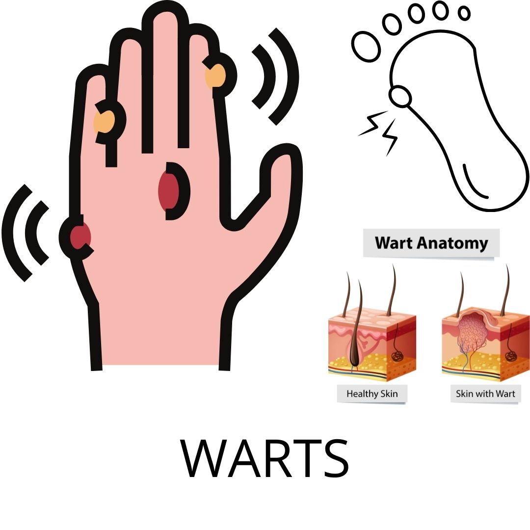 GET RID OF WARTS FOREVER WITH HOMEOPATHY