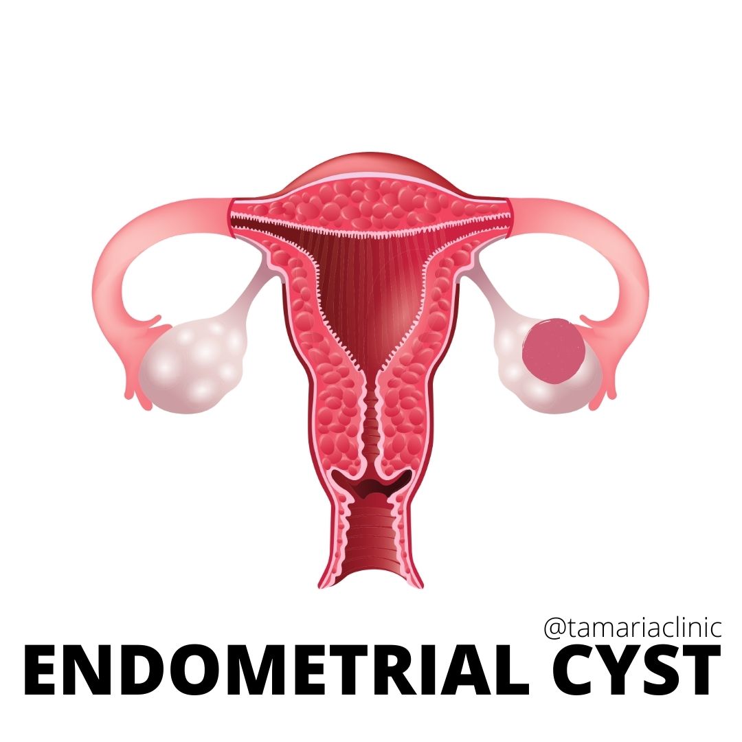 ALL YOU NEED TO KNOW ABOUT ENDOMETRIAL CYSTS!!