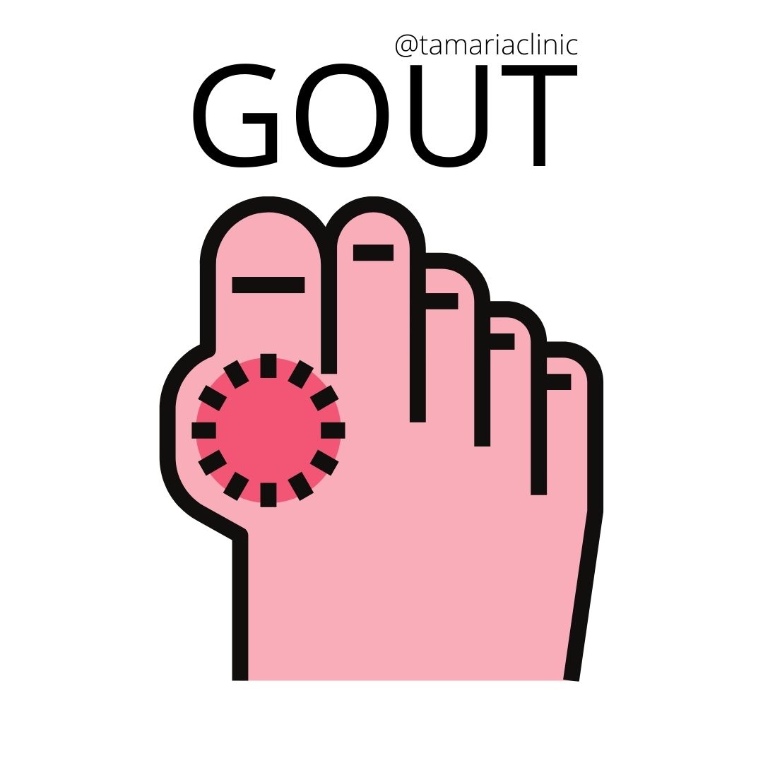 7 WARNING SIGNS TO LOOK FOR GOUT