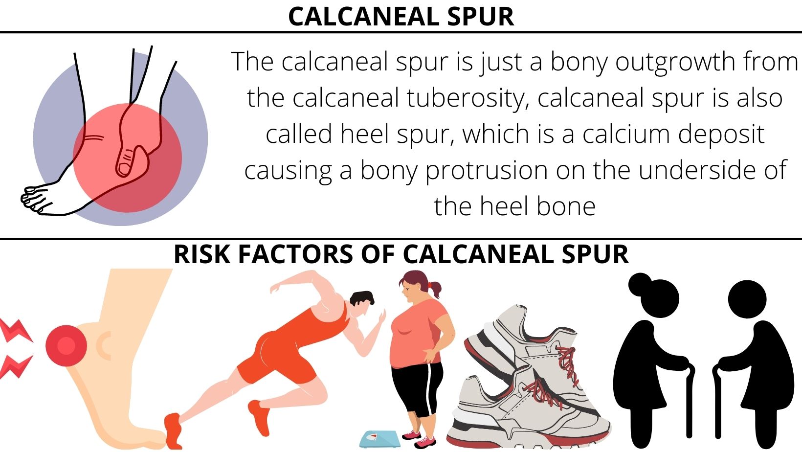 Heel spur  causes & treatment