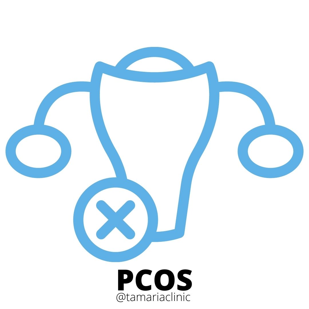 12 TIPS TO MANAGE PCOS FOR WOMEN AND YOUNG ADULT FEMALE