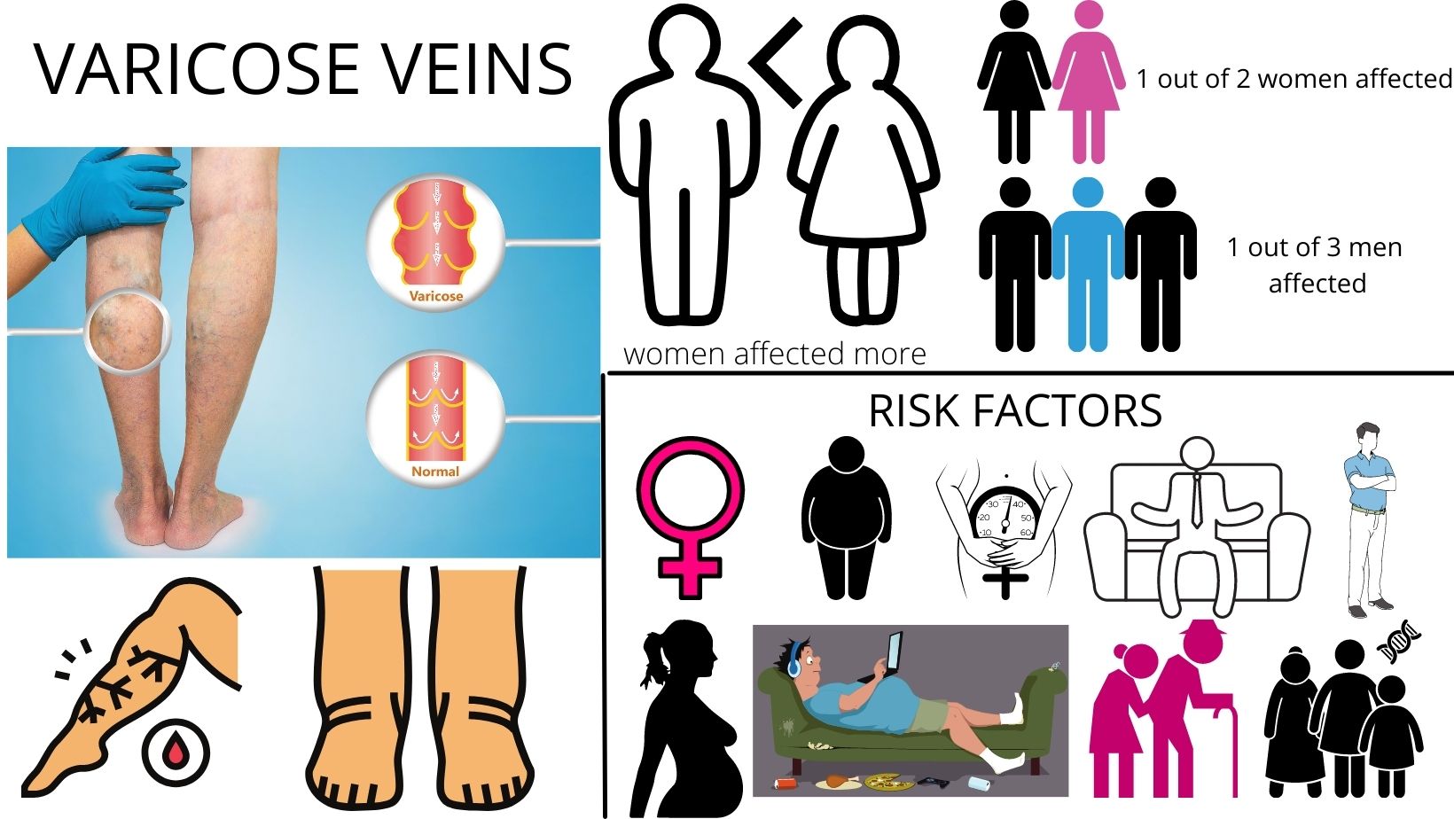 Varicose Veins: Symptoms, Risk Factors, Treatment