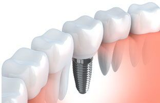 Dental Implants