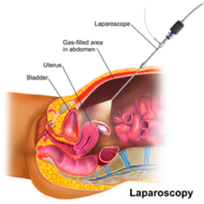 Laparoscopy - Wikipedia, the free encyclopedia
