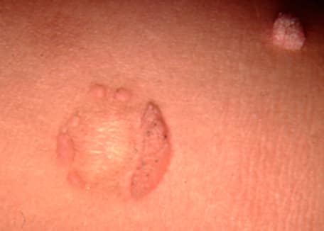 puss out of penis Puss out of penis