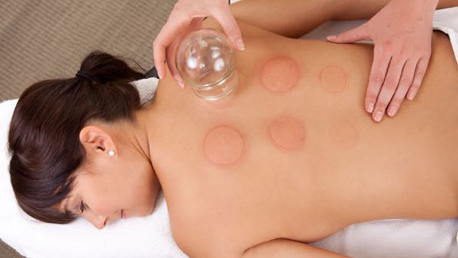 Cupping on the back of a woman with cupping marks