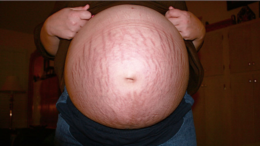 What Causes Stretch Marks During Pregnancy |