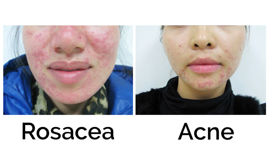 4 Types Of Rosacea And Their Differences From Acne Dermveda