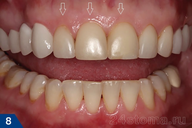 Композитные виниры на 3х верхних резцах - через 4,5 года после их установки