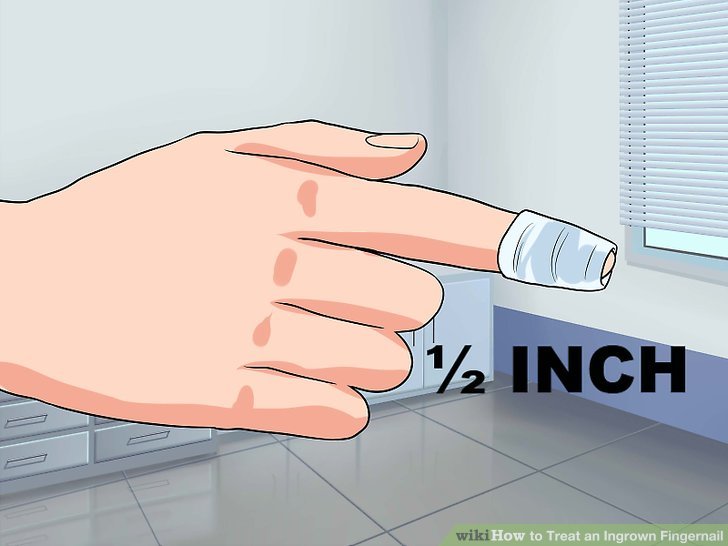 Image titled Treat an Ingrown Fingernail Step 1