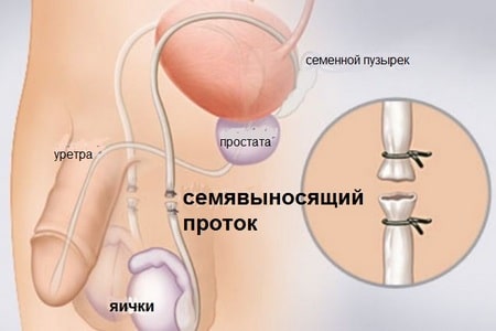 Особенности химической кастрации