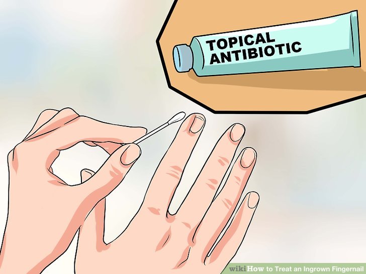 Image titled Treat an Ingrown Fingernail Step 2