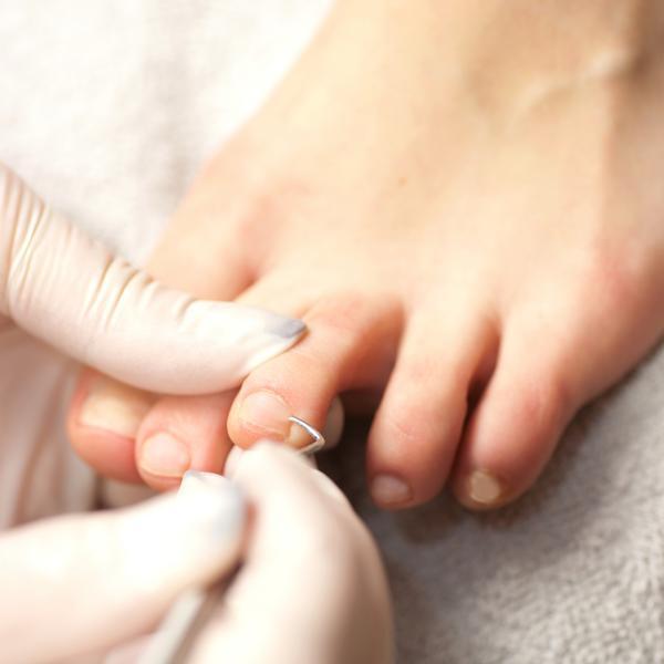 Do any home remedies really cure ingrown nails?