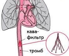 можно ли рожать самой при варикозе