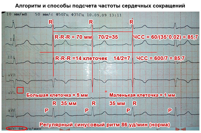 Кардиограмма сердца здорового человека фото и описание какая должна быть у женщин