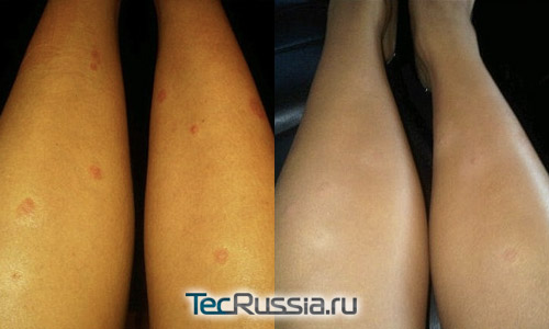 Ким Кардашян сделала плазмолифтинг