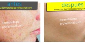 manchas por acne