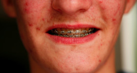 acne juvenil, causas del acne, dermatologo acne,