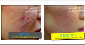 tratamiento para cicatrices y marcas de acne