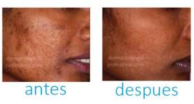 marcas de acne