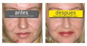 tratamiento acne adulto, tratamiento para acne adulto, acne adulto, dermatologo acne