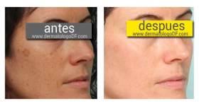 tratamiento para manchas, tratamiento para manchas en la cara, tratamiento para manchas en la cara