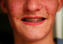 acne juvenil, causas del acne, dermatologo acne,