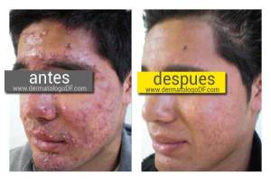 tratamiento para el acne