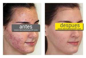 tratamiento para el acne