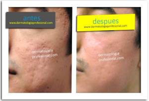 acne, que hace un dermatologo, tratamientos para acne, cicatrices, imagenes del acne, eliminar las cicatrices, quitar manchas de la piel, marcas en la cara, imagenes de acne