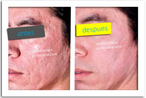 acne, que hace un dermatologo, tratamientos para acne, cicatrices, imagenes del acne, eliminar las cicatrices, quitar manchas de la piel, marcas en la cara, imagenes de acne