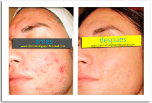 tratamiento para el acne