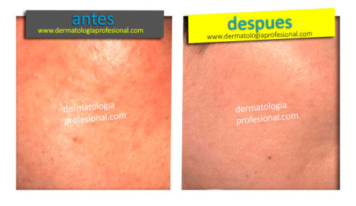 Antes y Despues