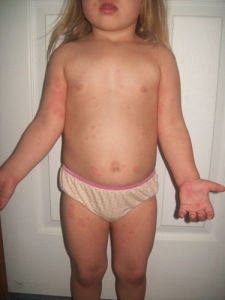 alergias, dermatitis, pediatra