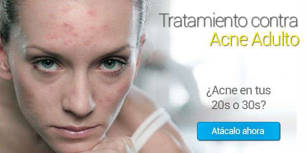 tratamiento acne adulto, tratamiento para acne adulto, acne adulto, dermatologo acne