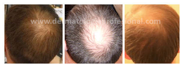 calvicie, perdida de cabello, caida de pelo, caida de cabello, alopecia, tratamiento para la caida del cabello, tratamiento para la caida del cabello, tratamiento para caida de cabello, caida de cabello, caida del pelo, calvicie, dermatologos especialistas en cabello, dermatologos especialistas en pelo, hay buenos dematologos para el cabello en mexico, tratamiento para la caida del cabello, tratamiento para la caida del pelo, caida cabello, caida de cabello mujeres, tratamiento caida de cabello, dermatologo calvicie, tratamiento calvicie mujeres, Tratamiento para caida de cabello, tratamiento caida de pelo