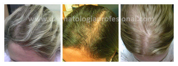 calvicie, perdida de cabello, caida de pelo, caida de cabello, alopecia, tratamiento para la caida del cabello, tratamiento para la caida del cabello, tratamiento para caida de cabello, caida de cabello, caida del pelo, calvicie, dermatologos especialistas en cabello, dermatologos especialistas en pelo, hay buenos dematologos para el cabello en mexico, tratamiento para la caida del cabello, tratamiento para la caida del pelo, caida cabello, caida de cabello mujeres, tratamiento caida de cabello, dermatologo calvicie, tratamiento calvicie mujeres, tratamiento para caida de cabello, tratamiento caida de pelo