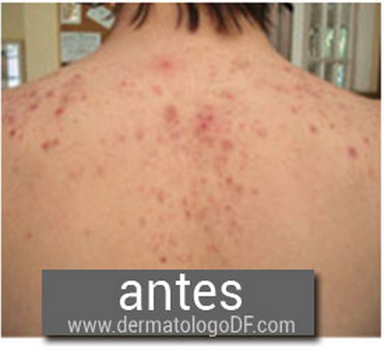 piel seca, cremas para piel seca, cremas dermatologicas para cara, cremas para la piel, cremas recomendadas por dermatologos, acne en espalda, acne en cuerpo, acne en la espalda, tratamiento para acne, tratamiento acne, tratamiento del acne,