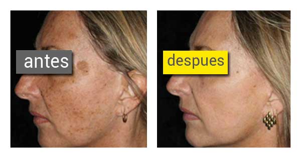 Como se librará de las pecas sobre la persona el foro