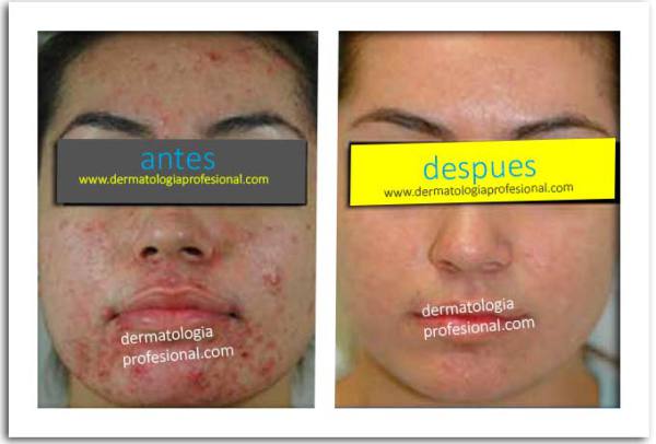 tratamiento para el acne, dermatologo acne, dermatologos acne, tratamiento para acne, imagenes acne, tratamiento acne severo, marcas en la cara, tratamiento del acne severo,