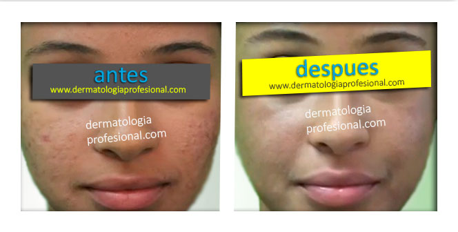 Bueno el medio de las pecas