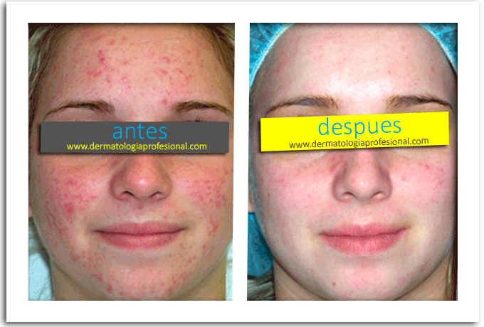 Super Intensivo Tratamiento Para El Acne Y Cicatrices 7552