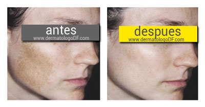 Las desapariciones por el láser de las pecas el precio