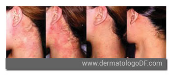 dermatitis