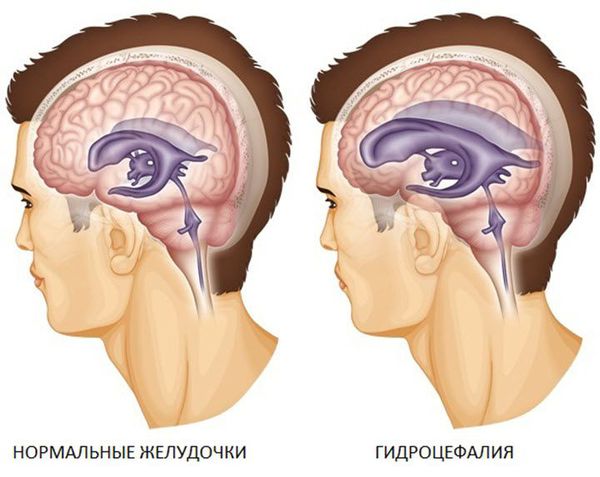 Гидроцефалия