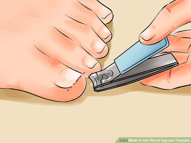 Image titled Remove an Ingrown Toenail Step 19