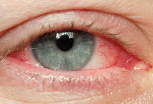 Eye redness is a symptom of pinkeye.